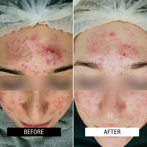 Case Study - Acne resurfacing treatments 2A - 2