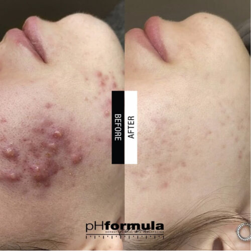 Case Study - Acne resurfacing treatments 3A - 2