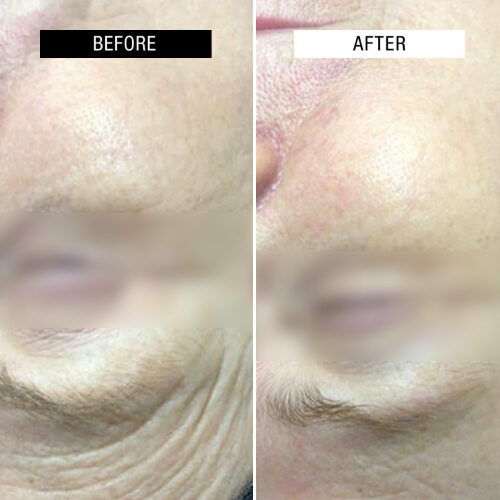 Case Study - Age resurfacing treatments 2A - 1