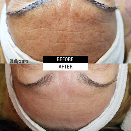 Case Study - Age resurfacing treatments 3A - 3