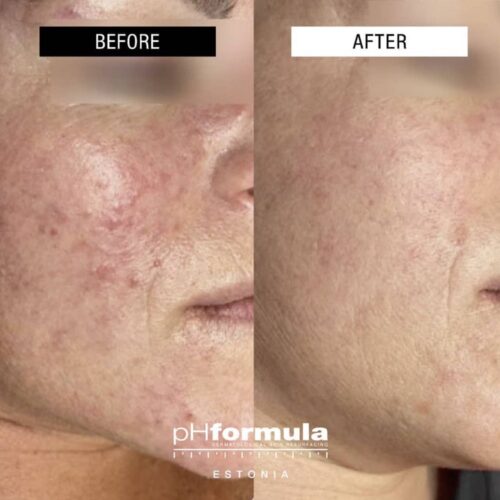 Case Study - Chronic redness resurfacing treatment - 3
