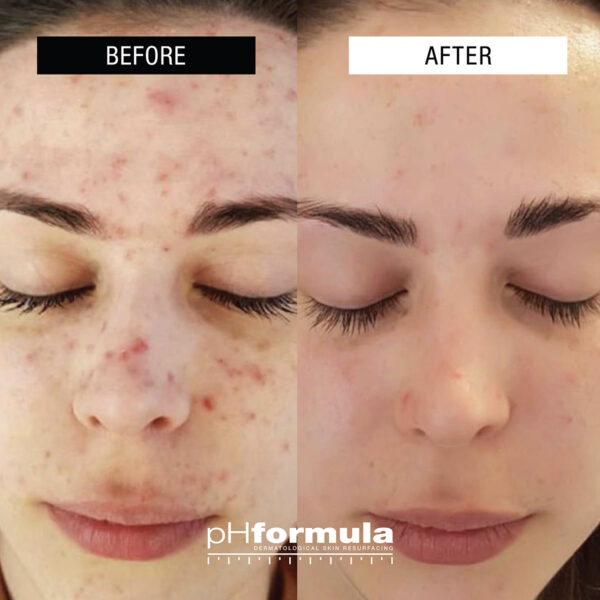 01-Treating adult acne