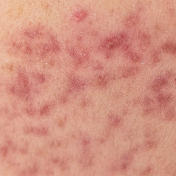 02-Treating the factors and Influences of Acne