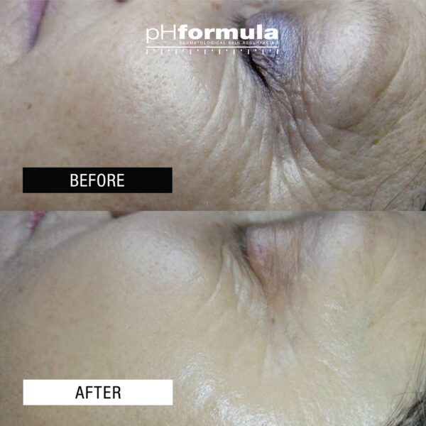 06-How to reduce wrinkles