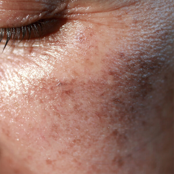 11-What does the sun do to your skin