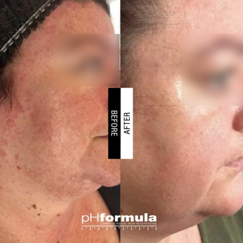 Case Study - Chronic redness resurfacing treatment - 1