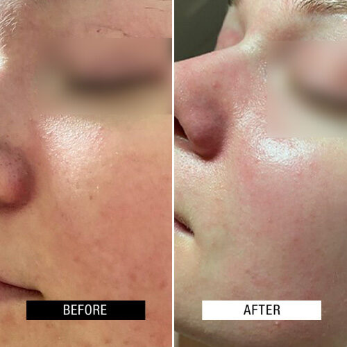 Case Study - Chronic redness resurfacing treatment - 2