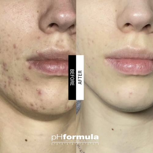 Case Study - Acne resurfacing treatments 2A - 1