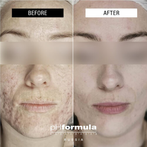 Case Study - Acne resurfacing treatments 3A - 3