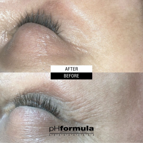 RESULTS - Age resurfacing treatments 3A - 1