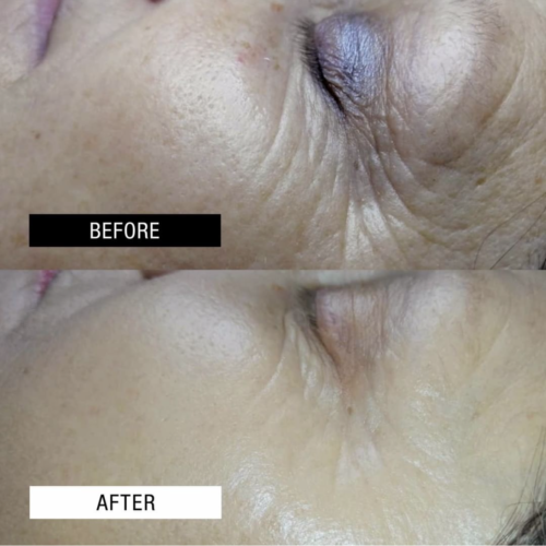 Case Study - Age resurfacing treatments 3A - 2