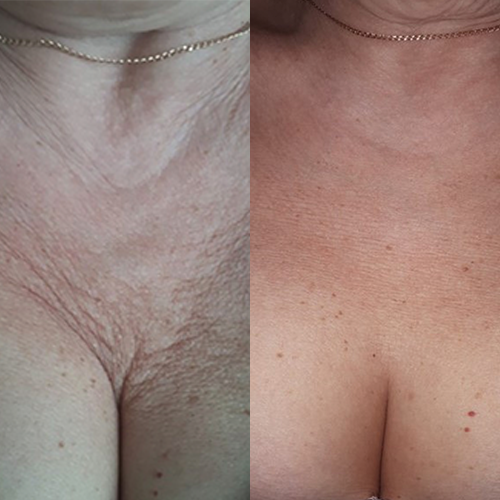 Case Study - Neck & décolleté resurfacing - 1