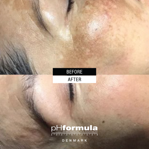 Case Study - Powerful hyper-pigmentation treatment - 1